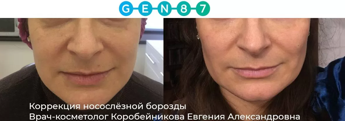 Фото до и после контурной пластики лба 31