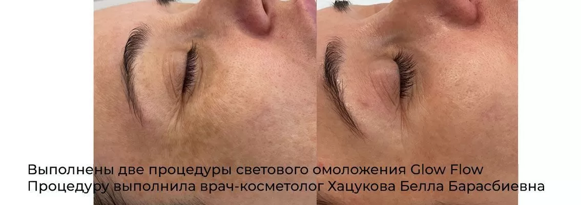 Фото результата удаления / лечения пигментных пятен 4
