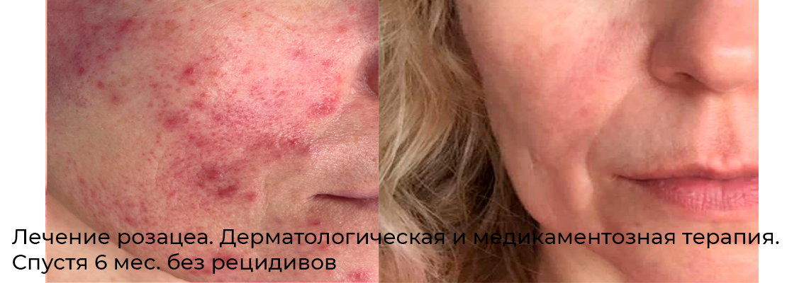 Фото результата лечения розацеа 1