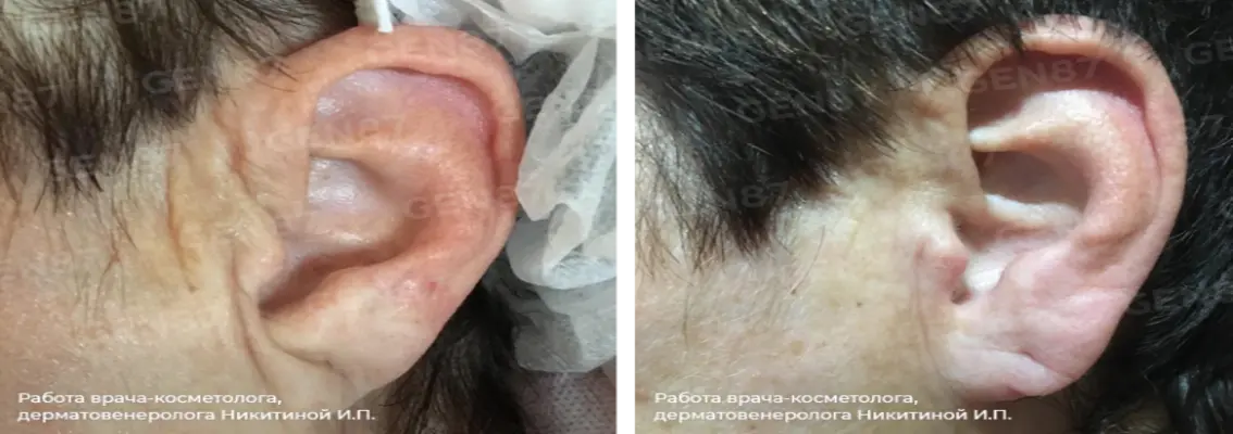Фотографии после процедуры контурной пластики подбородка 17