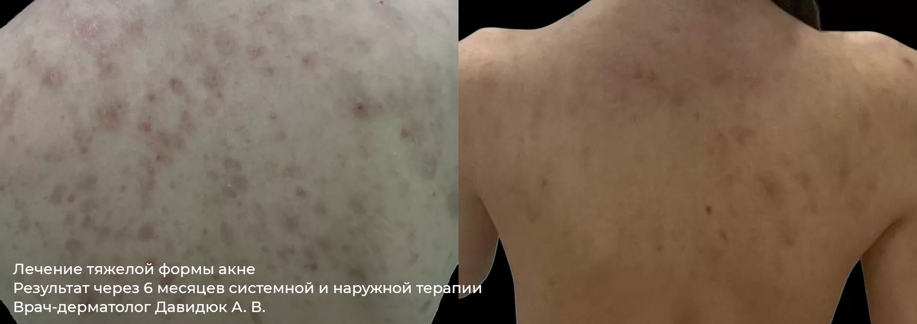 Фото до и после процедуры лечения акне, угревой сыпи 2