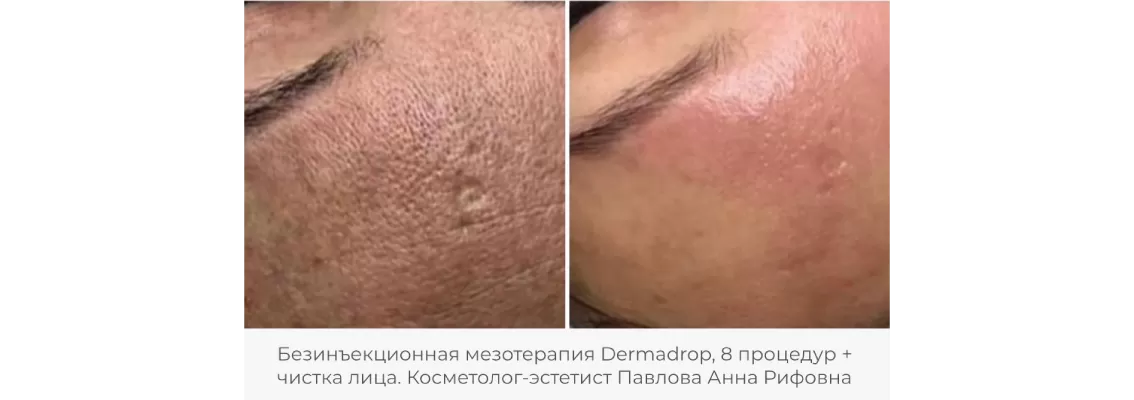 Фото до и после процедуры безинъекционной мезотерапии 5
