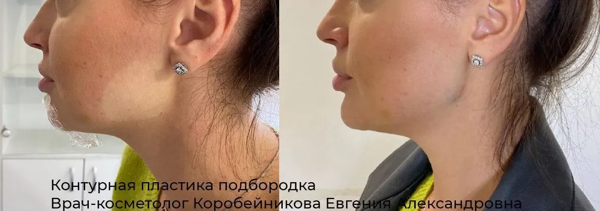 Фото результата контурной пластики лба 27