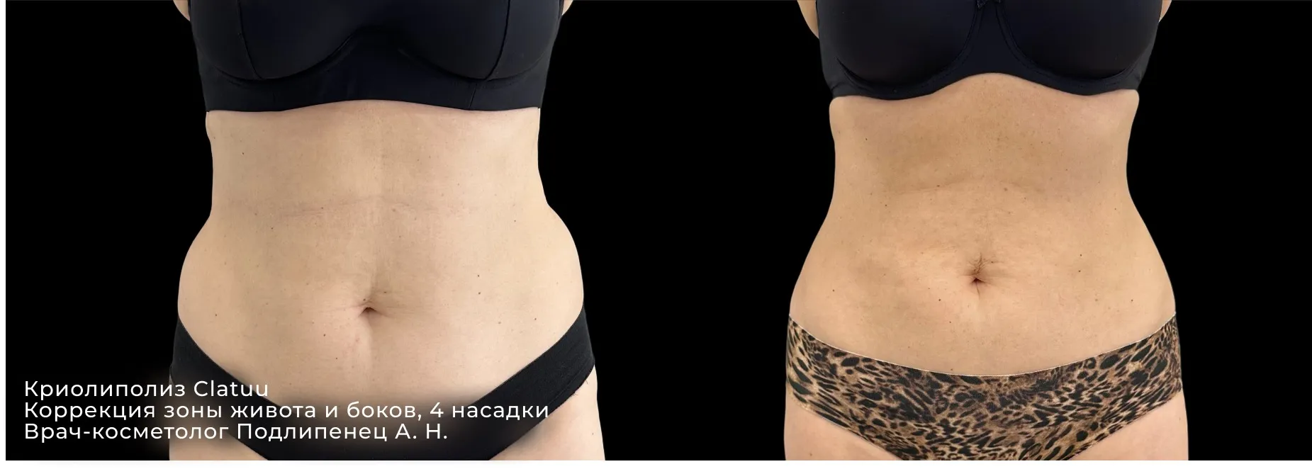 Фотографии после процедуры криолиполиза рук 2