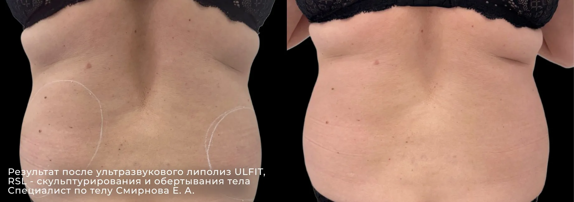 Фото до и после процедуры ультразвуковой липосакции 2