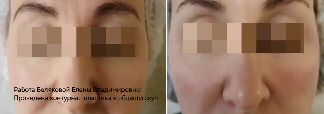 Фото до и после процедуры контурной пластики углов нижней челюсти 21