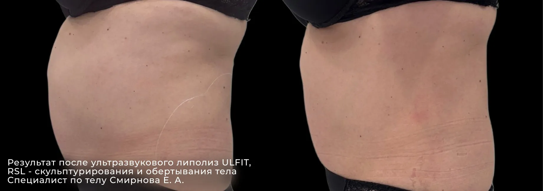 Фотографии после процедуры ультразвуковой липосакции второго подбородка 2