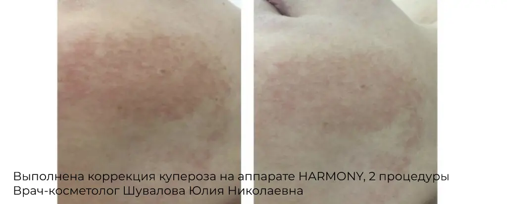 Фото до и после фракционного термолиза кожи лица 1