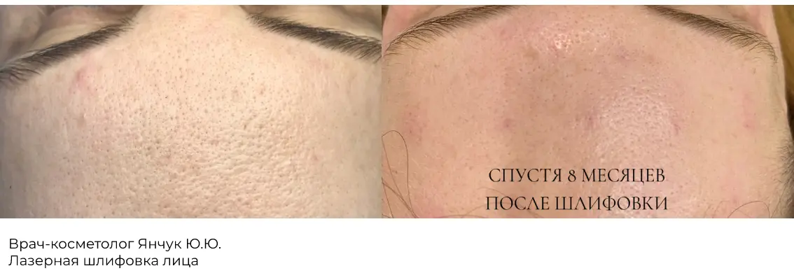 Фотографии после процедуры лазерной шлифовки спины 9