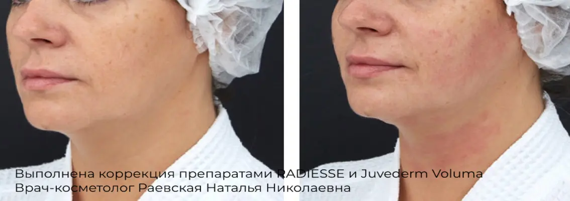 Фотографии после процедуры контурной пластики лба 16