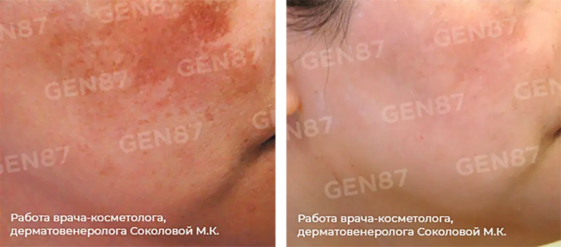 Фото до и после процедуры удаления / лечения пигментных пятен 2