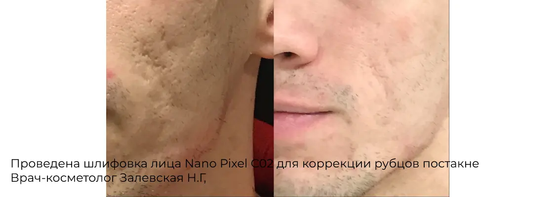 Фото до и после лазерной шлифовки груди 8
