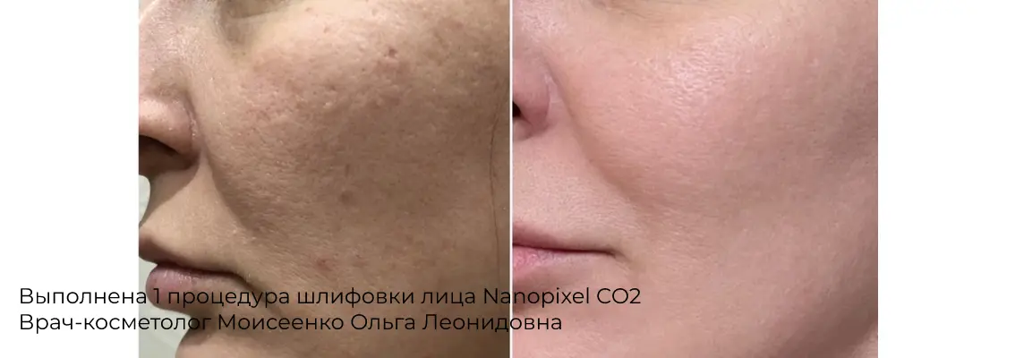 Фотографии после процедуры лазерной шлифовки спины 8