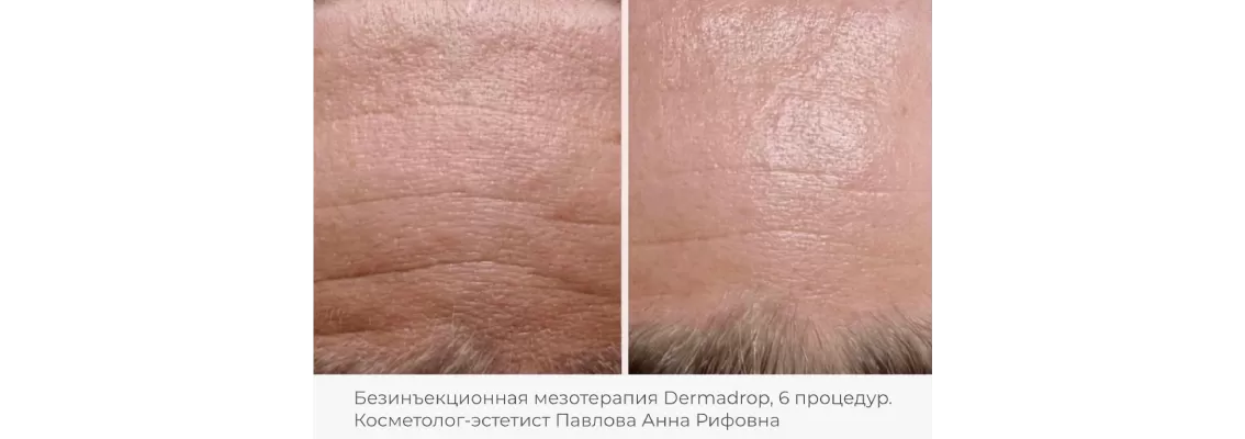 Фотографии после процедуры безинъекционной мезотерапии 5