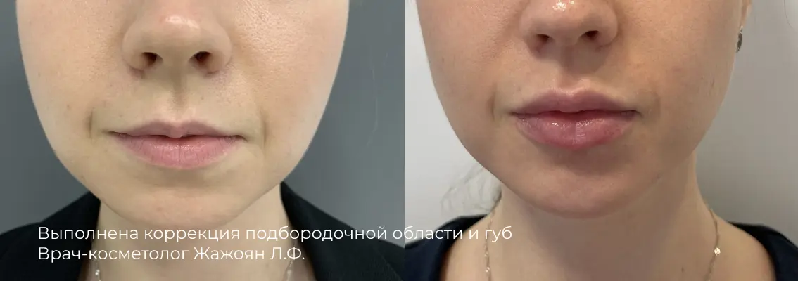 Фотографии после процедуры контурной пластики лба 15