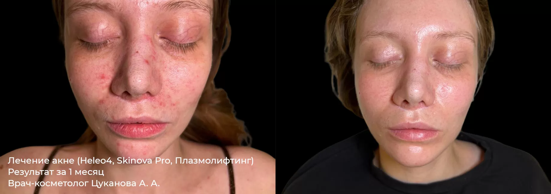 Фотографии после процедуры лечения акне, угревой сыпи 1