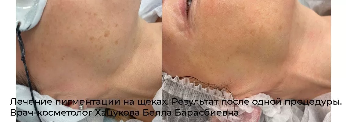 Фотографии после процедуры удаления / лечения пигментных пятен 3