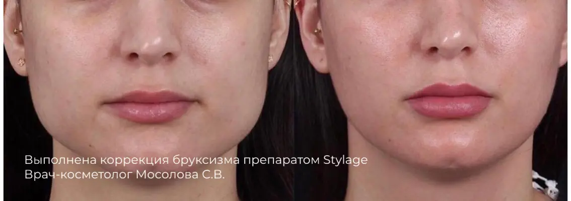Фото до и после контурной пластики углов нижней челюсти 24
