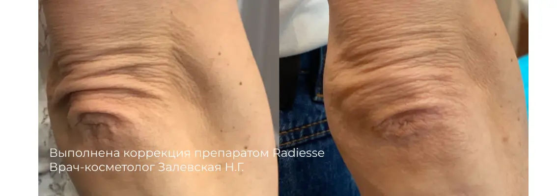 Фото результата контурной пластики углов нижней челюсти 23
