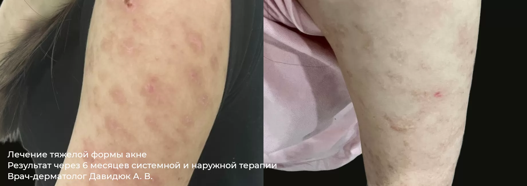 Фото до и после лечения акне, угревой сыпи 3