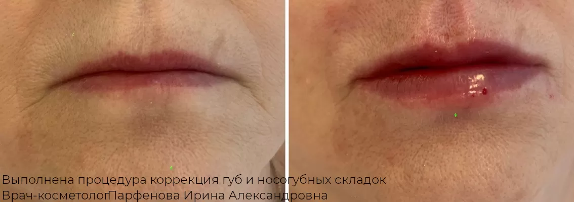 Фото до и после процедуры контурной пластики лба 31
