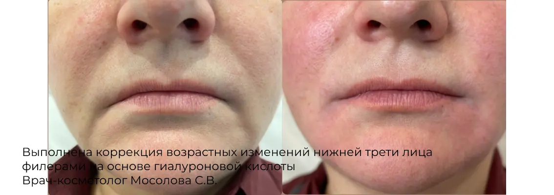 Фото результата контурной пластики углов нижней челюсти 15