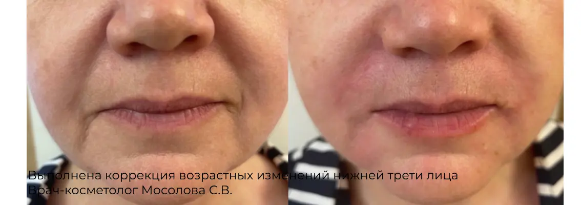 Фото до и после процедуры контурной пластики подбородка 14