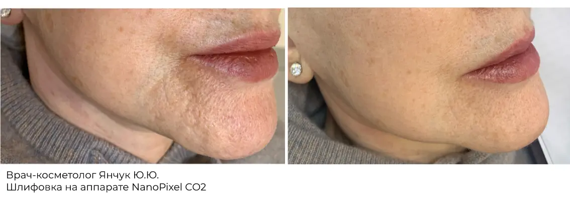 Фото до и после процедуры лазерной шлифовки груди 9