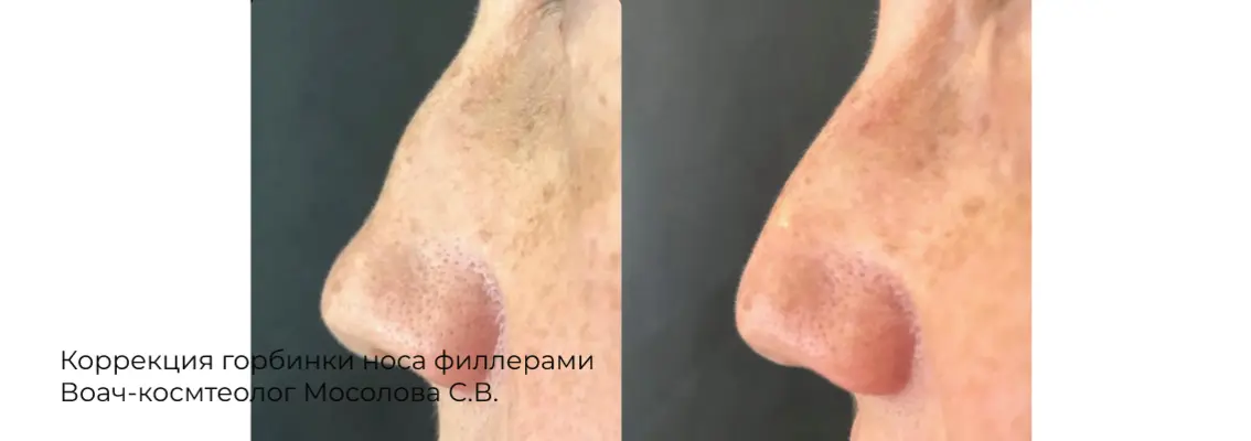 Фото результата контурной пластики лба 24