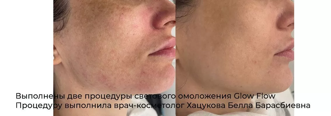 Фотографии после процедуры удаления / лечения пигментных пятен 4