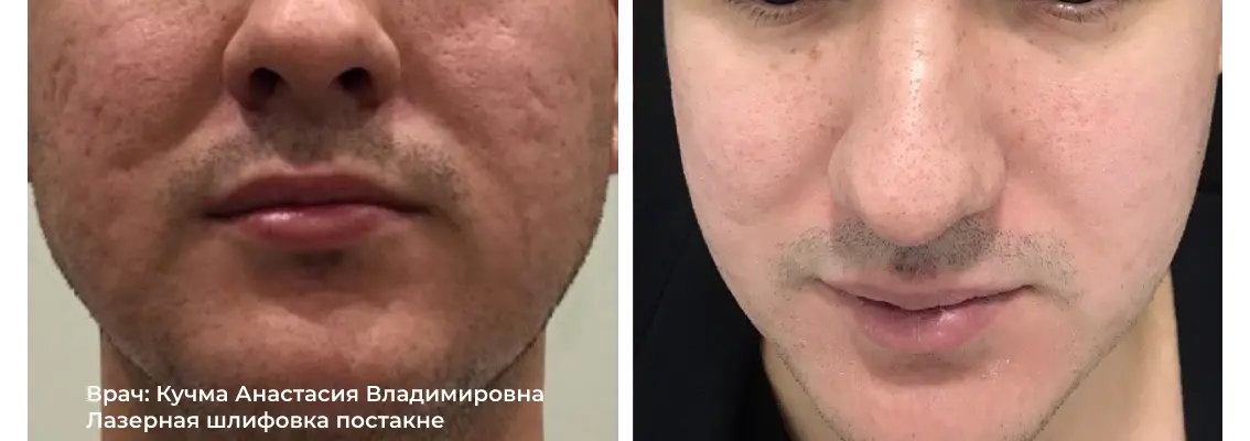 Фото до и после процедуры лазерной шлифовки груди 8