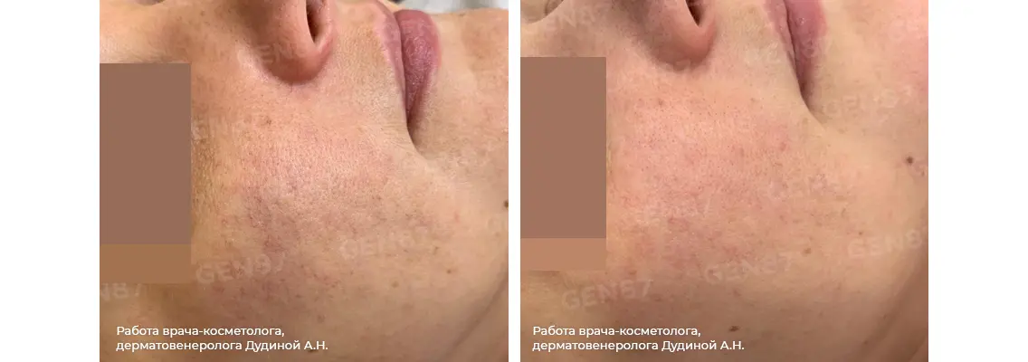 Фотографии после процедуры фракционного термолиза кожи лица 1