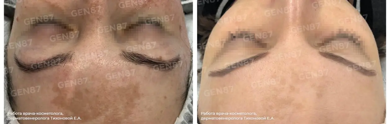 Фотографии после процедуры удаления / лечения пигментных пятен 2